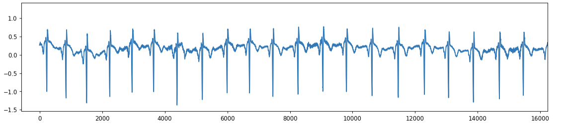 ECG inverted